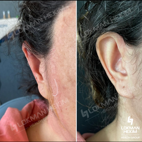 Ear correction surgery (Otoplasty) Before / After photo
